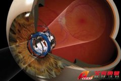 植入式望遠(yuǎn)鏡